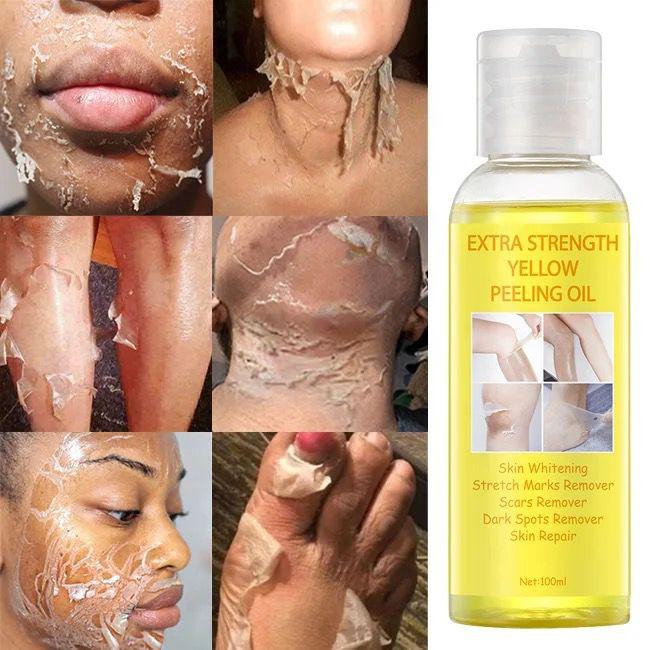 Extra strength yellow peeling oil For stretch marks and dark spots etc. 5